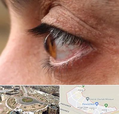 متخصص قوز قرنیه در پرند