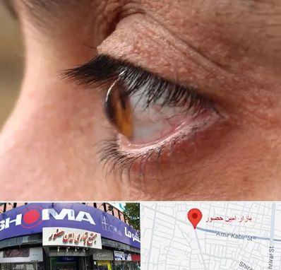 متخصص قوز قرنیه در امین حضور