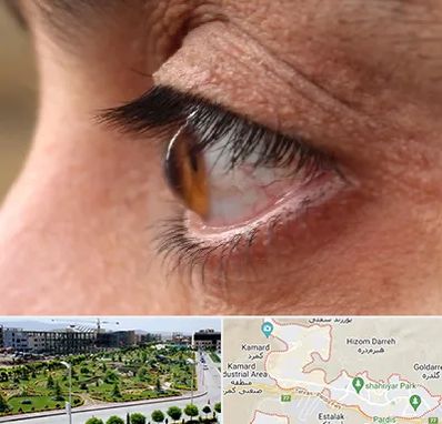 متخصص قوز قرنیه در پردیس