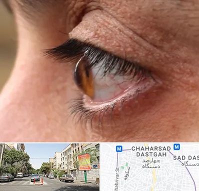 متخصص قوز قرنیه در چهارصد دستگاه 
