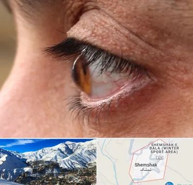 متخصص قوز قرنیه در شمشک