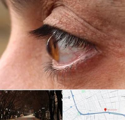 متخصص قوز قرنیه در ابوریحان تبریز