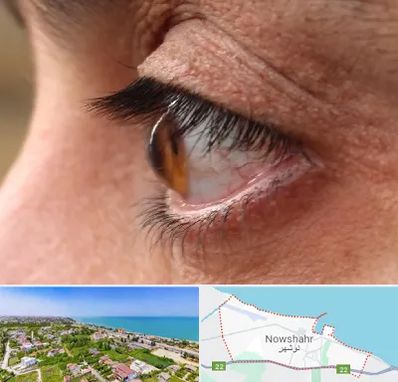 متخصص قوز قرنیه در نوشهر