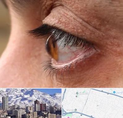 متخصص قوز قرنیه در ازگل