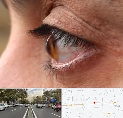 متخصص قوز قرنیه در دولت 