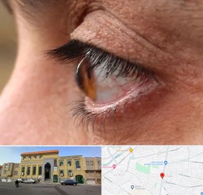 متخصص قوز قرنیه در زنبیل آباد قم