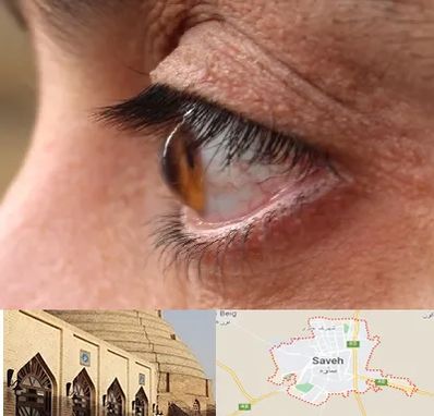 متخصص قوز قرنیه در ساوه
