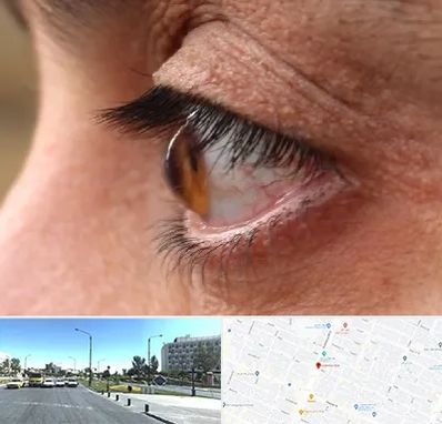 متخصص قوز قرنیه در بلوار کلاهدوز مشهد 