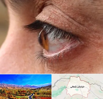 متخصص قوز قرنیه در خراسان شمالی