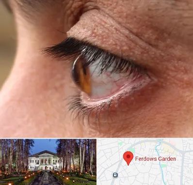 متخصص قوز قرنیه در باغ فردوس