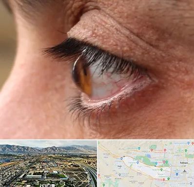 متخصص قوز قرنیه در منطقه 21 تهران 