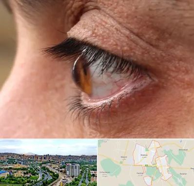 متخصص قوز قرنیه در شهریار