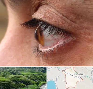 متخصص قوز قرنیه در گچساران