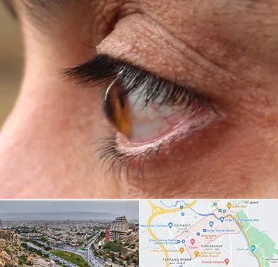 متخصص قوز قرنیه در معالی آباد شیراز