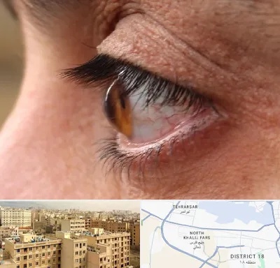 متخصص قوز قرنیه در جنوب غرب تهران