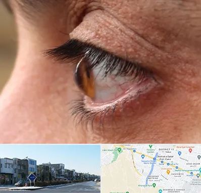 متخصص قوز قرنیه در شریعتی مشهد