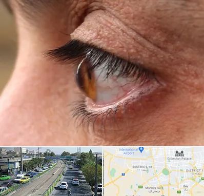 متخصص قوز قرنیه در جنوب تهران 