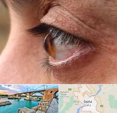 متخصص قوز قرنیه در دزفول