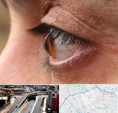 متخصص قوز قرنیه در ستارخان شیراز