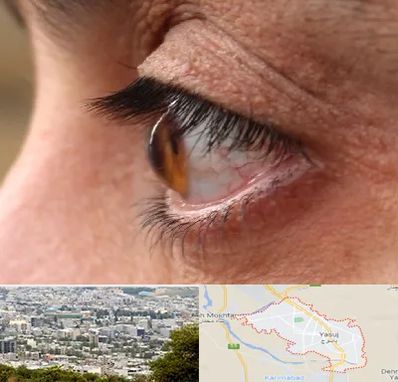 متخصص قوز قرنیه در یاسوج