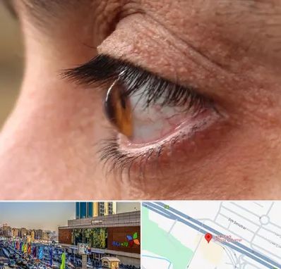 متخصص قوز قرنیه در لاله پارک تبریز