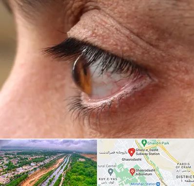 متخصص قوز قرنیه در قصرالدشت شیراز