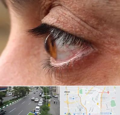 متخصص قوز قرنیه در ستارخان 