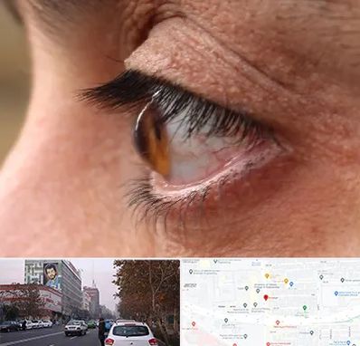 متخصص قوز قرنیه در کارگر شمالی 