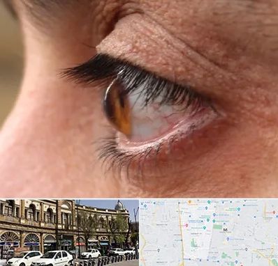 متخصص قوز قرنیه در منطقه 11 تهران 