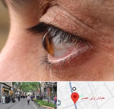 متخصص قوز قرنیه در ولیعصر شهریار