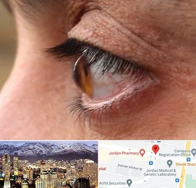 متخصص قوز قرنیه در جردن 