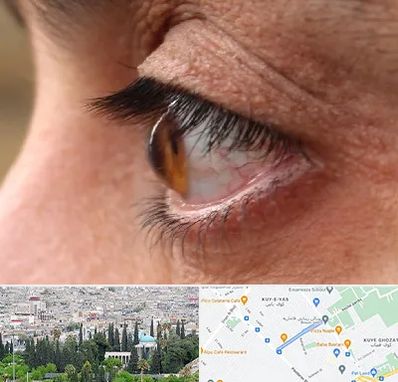 متخصص قوز قرنیه در محلاتی شیراز