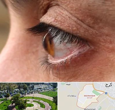 متخصص قوز قرنیه در مهرشهر کرج 