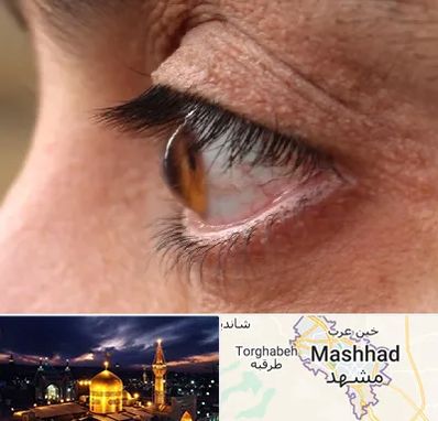 متخصص قوز قرنیه در مشهد