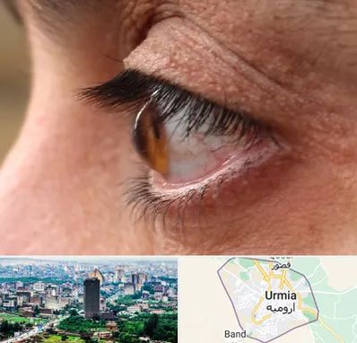 متخصص قوز قرنیه در ارومیه