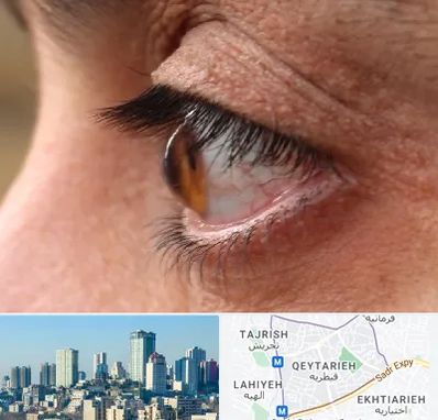 متخصص قوز قرنیه در قیطریه 