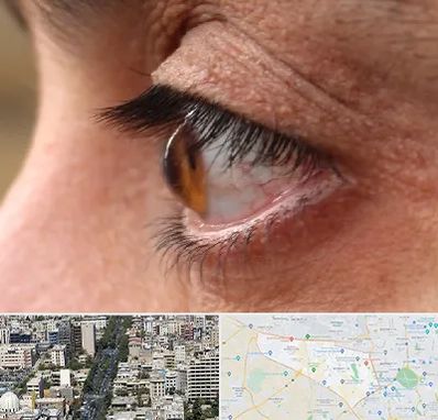 متخصص قوز قرنیه در منطقه 18 تهران 