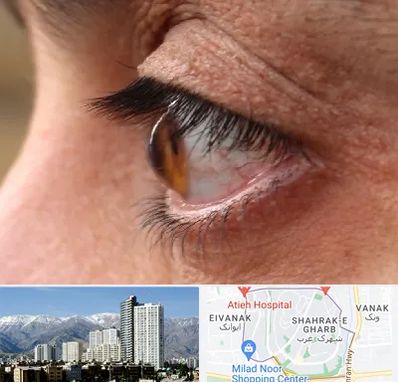متخصص قوز قرنیه در شهرک غرب 