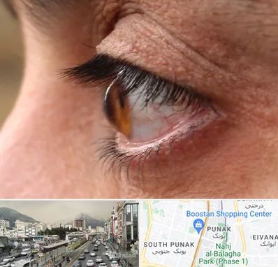 متخصص قوز قرنیه در پونک 