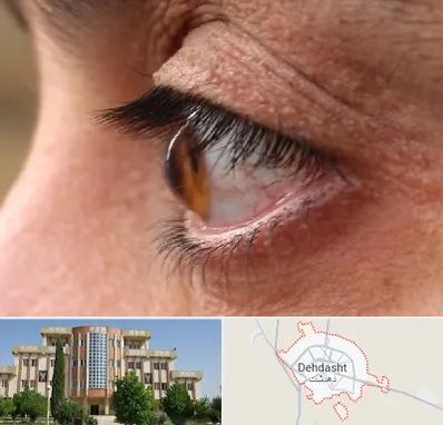 متخصص قوز قرنیه در دهدشت