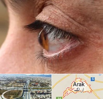 متخصص قوز قرنیه در اراک
