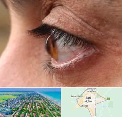 متخصص قوز قرنیه در ساری