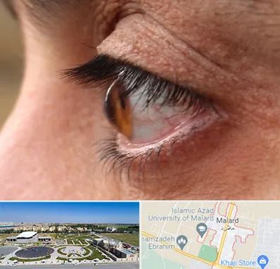 متخصص قوز قرنیه در ملارد