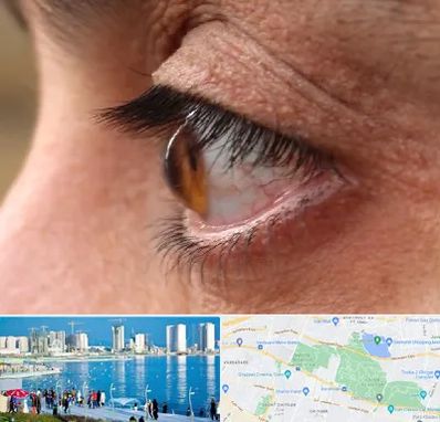 متخصص قوز قرنیه در چیتگر 