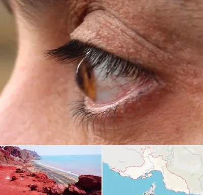 متخصص قوز قرنیه در هرمزگان