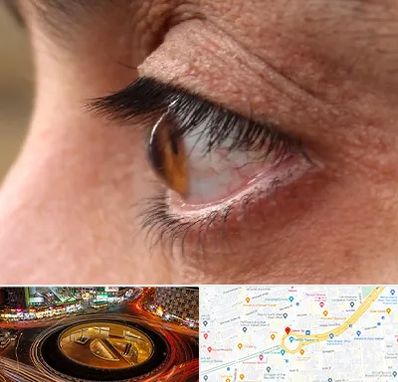 متخصص قوز قرنیه در میدان ولیعصر 