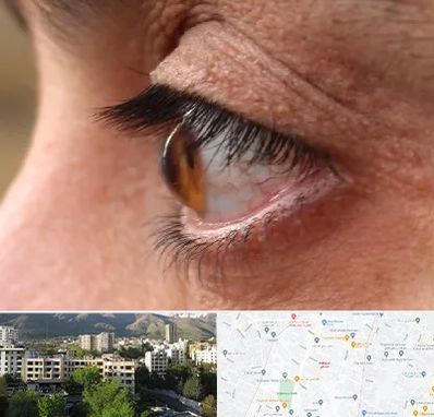 متخصص قوز قرنیه در دیباجی 