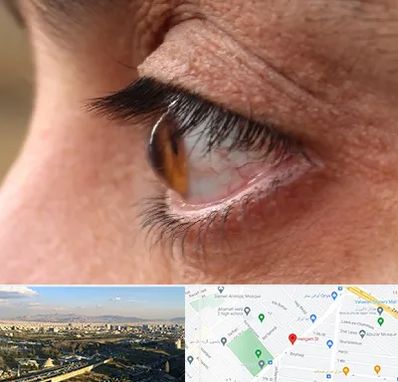 متخصص قوز قرنیه در هنگام 