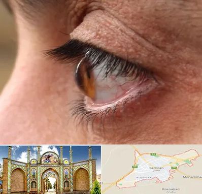 متخصص قوز قرنیه در سمنان