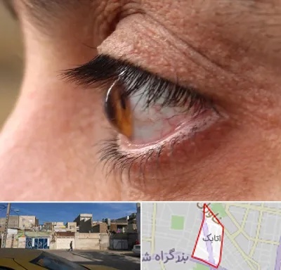 متخصص قوز قرنیه در اتابک